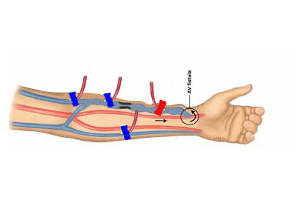 Peripheral Arteriovenous Fistula